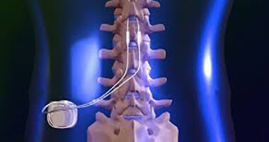 Who May Benefit from Spinal Cord Stimulation