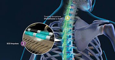 FDA approves Abbott's spinal cord stimulators for back pain
